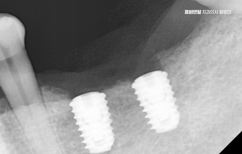 어금니 발치후 임플란트 안하면 어떻게 변하는걸까 관련 이미지 7
