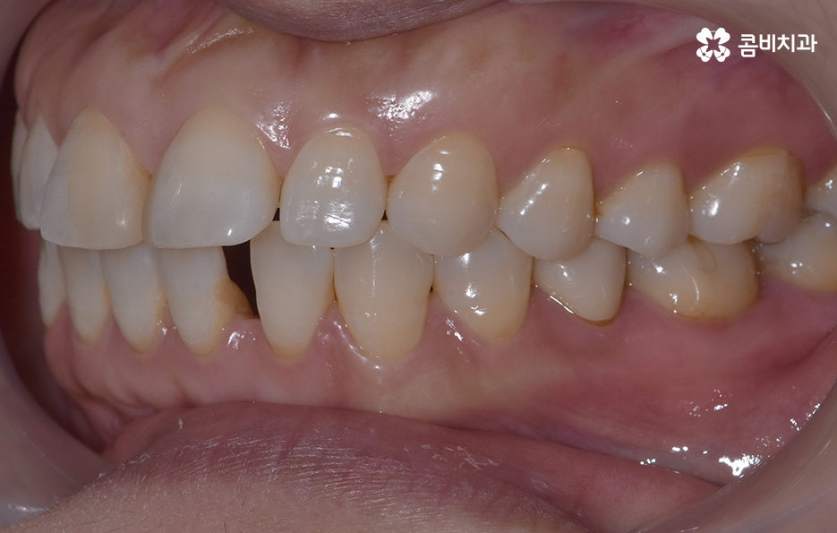 중년치아교정 이제라도 해도 될까요 관련 이미지 3