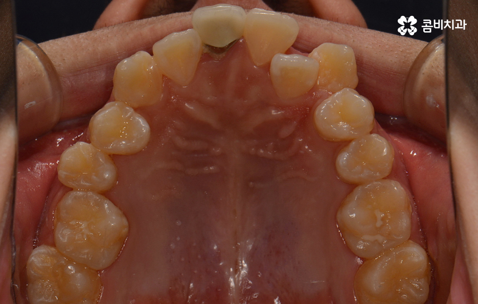 덧니교정 불편함이 느껴지지 않더라도 관련 이미지 4