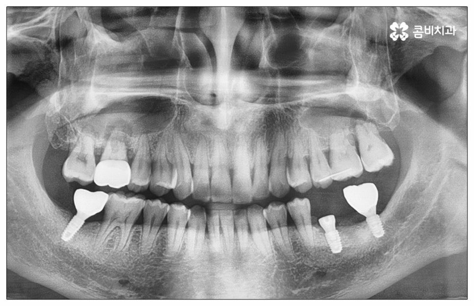 건강보험임플란트 혜택받아 보세요 관련 이미지 6
