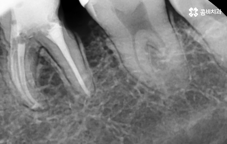치아 사이 충치 까다로운 이유부터 알아보시죠 관련 이미지 6