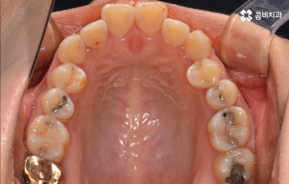 클리피씨교정 알아볼 때 꼭 신경 써야 하는 점은! 관련 이미지 4