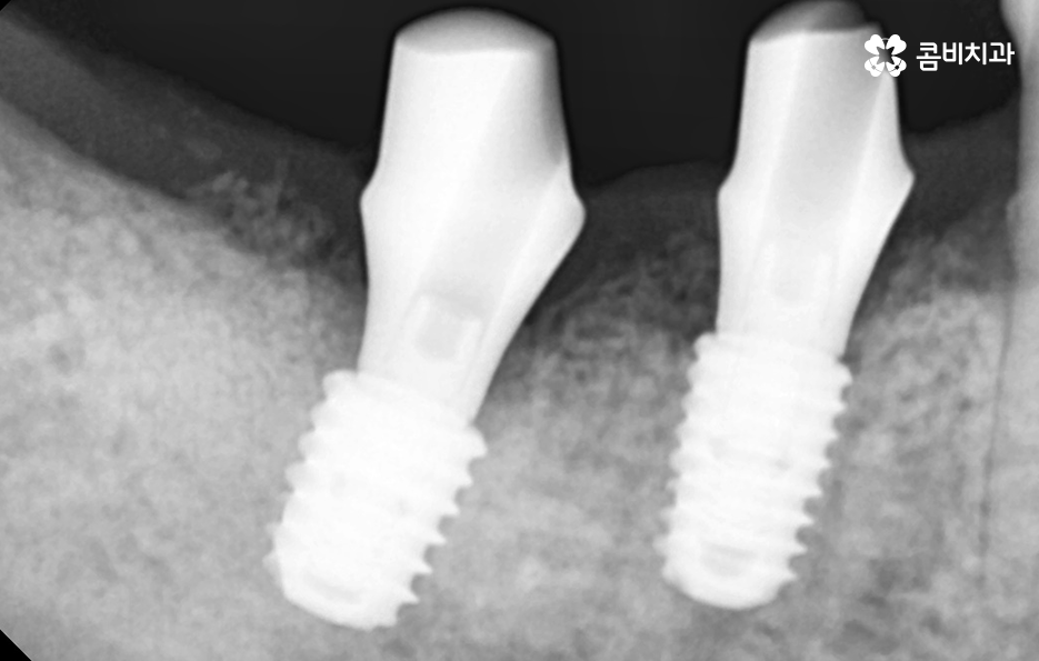 건강보험 임플란트 적용 받기 전에 알아두세요 관련 이미지 9