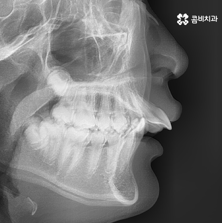 튀어나온입 치아교정으로 개선이 가능할까 관련 이미지 1