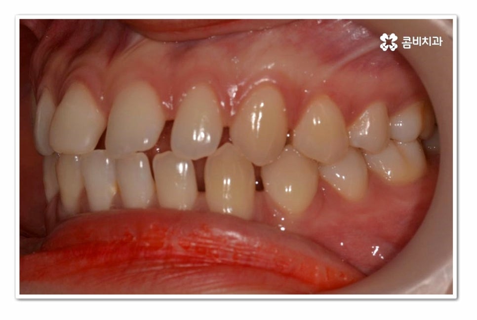 앞니 벌어짐 똑똑하게 해결하려면 관련 이미지 3