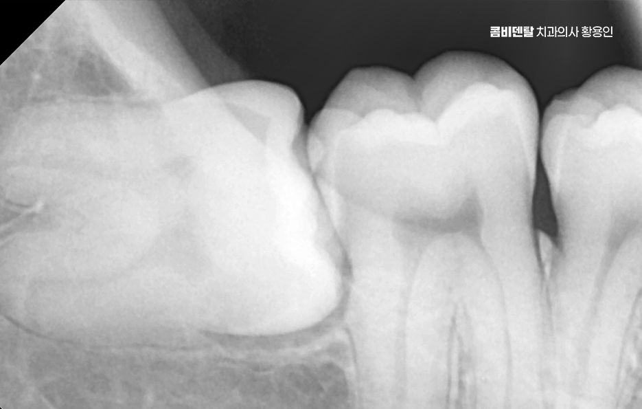 완전매복사랑니 발치 대학병원 꼭 가야하나요 관련 이미지 3