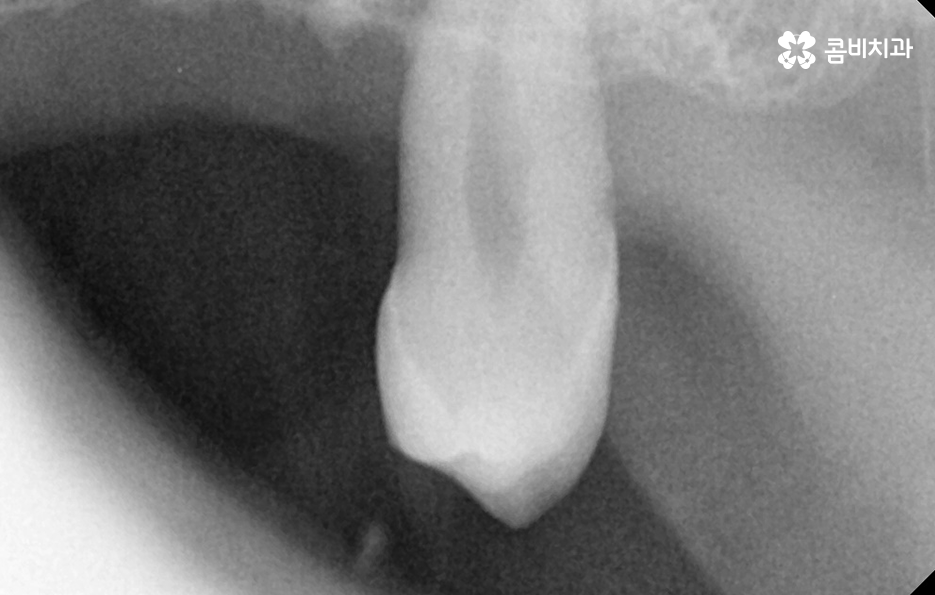 65세이상 임플란트 개수 구체적으로 체크하려면 관련 이미지 7