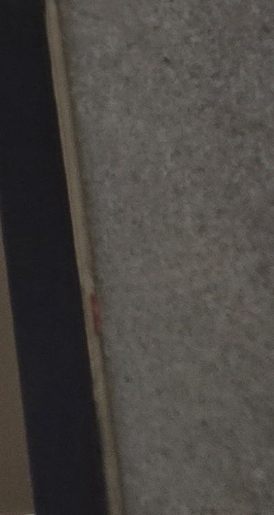 반대교합 치아교정 해결 가능할까 관련 이미지 46