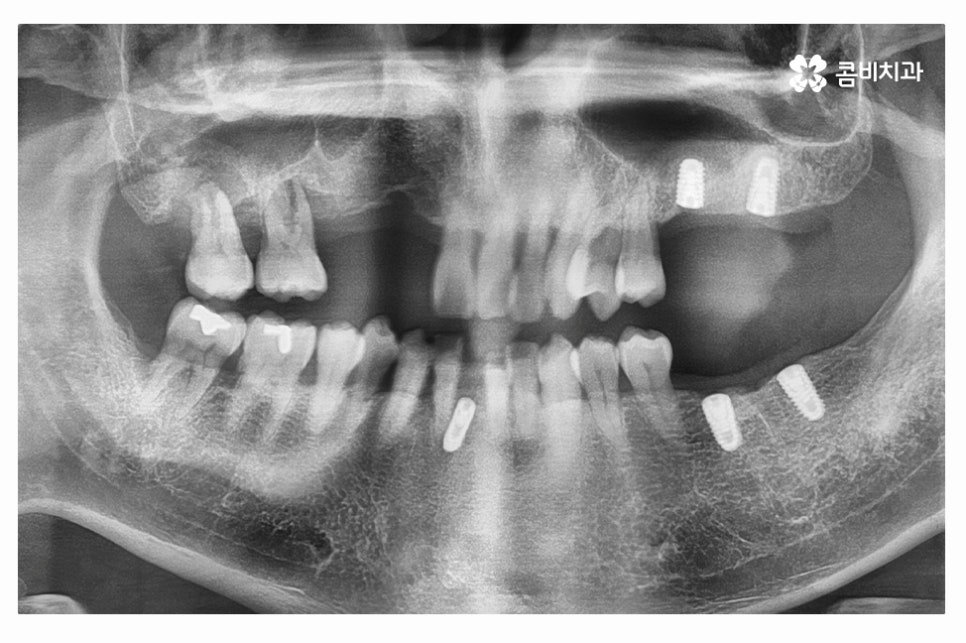 임플란트 수술 신중하게 결정하려면 관련 이미지 2