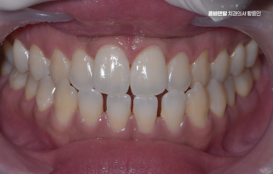 클리피씨교정 장단점 어떻게 비교하면 될까요 관련 이미지 1