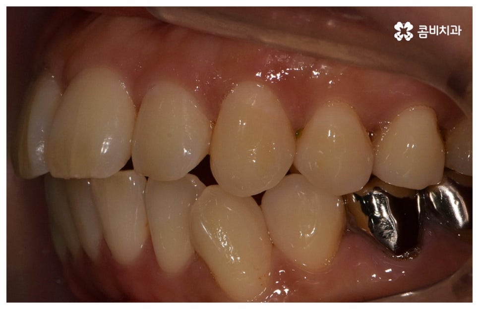 중년치아교정 원한다면 관련 이미지 4