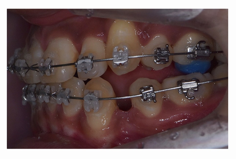 덧니 발치 필수적으로 하는건가요 관련 이미지 13