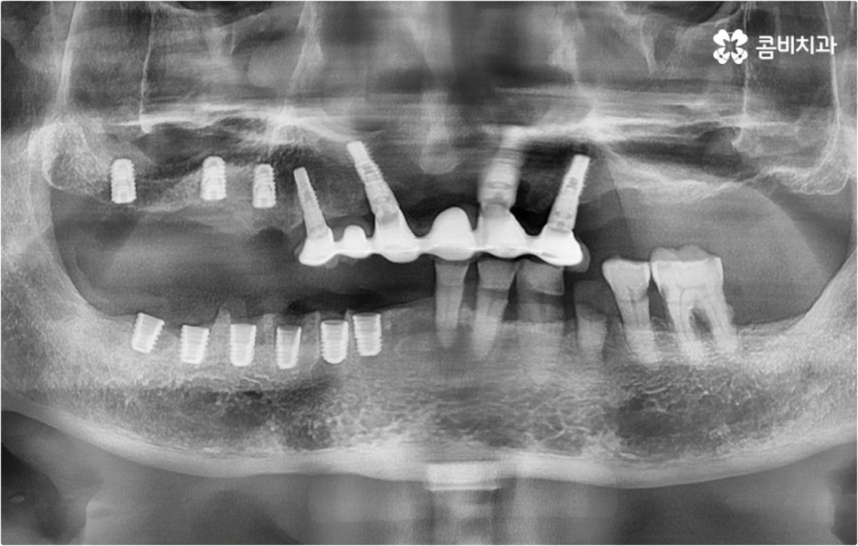전악임플란트 고려할 사항들은 관련 이미지 10