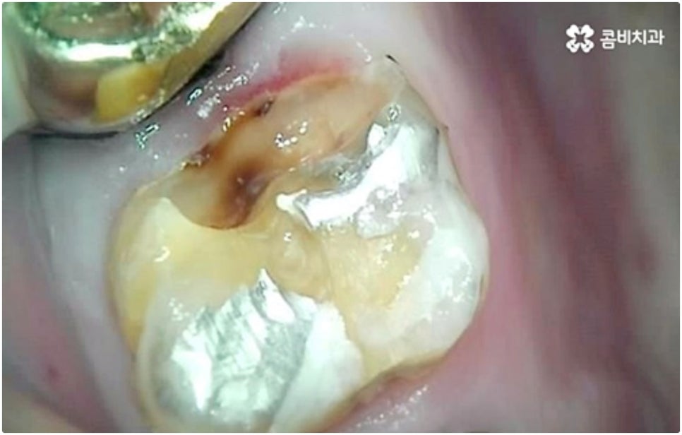 어금니임플란트 살펴볼 사항들은 무엇인가요? 관련 이미지 3
