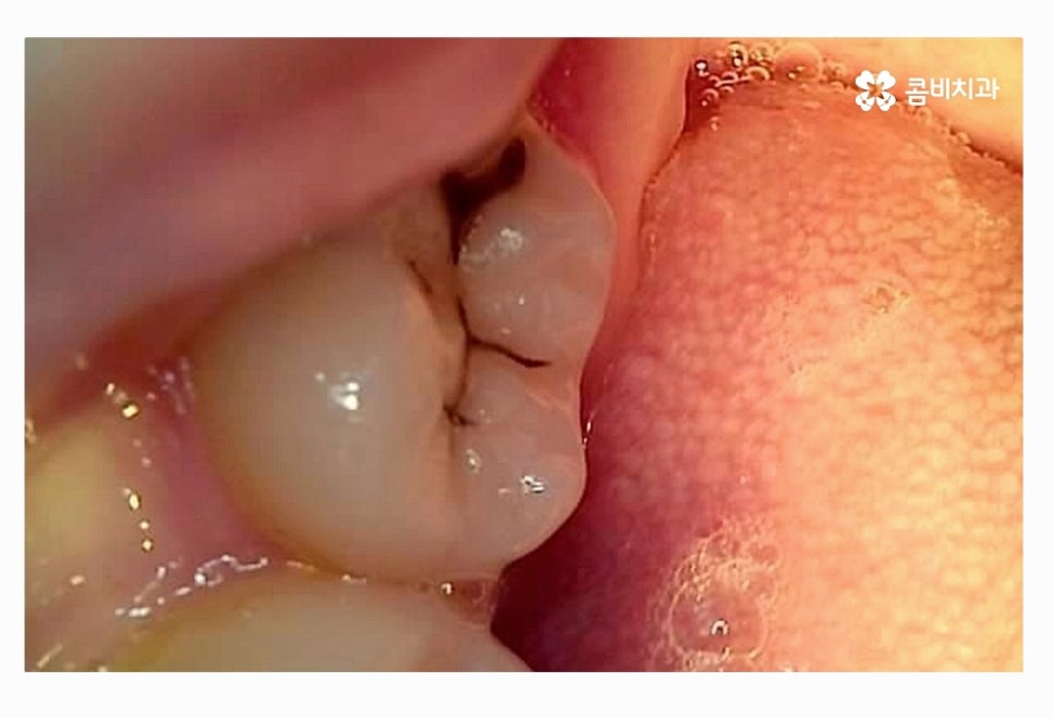 사랑니 충치 현명하게 접근하려면 관련 이미지 5