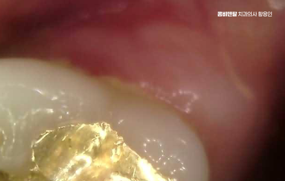 인레이 치료 후 통증 자꾸 심해지는데 괜찮은걸까 관련 이미지 7
