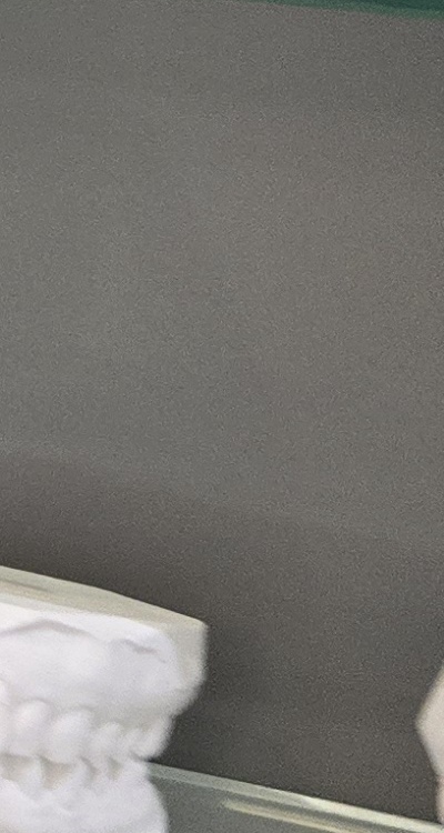 윗니 전체 임플란트 뭐부터 해야할까 관련 이미지 36