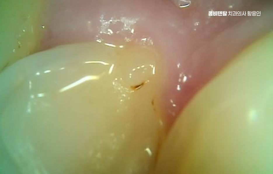 어금니 충치 단계 미리 알아차리려면 관련 이미지 3