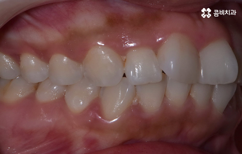 앞니 틀어짐 교정 방법 이럴때는 좀더 간단해요 관련 이미지 3