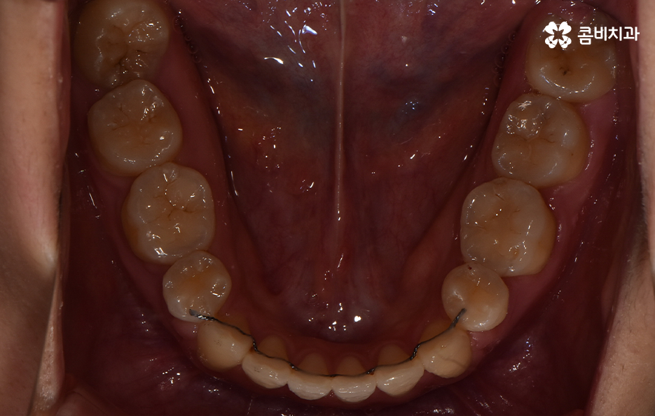 돌출입발치교정 기대해봐도 될까요 관련 이미지 15