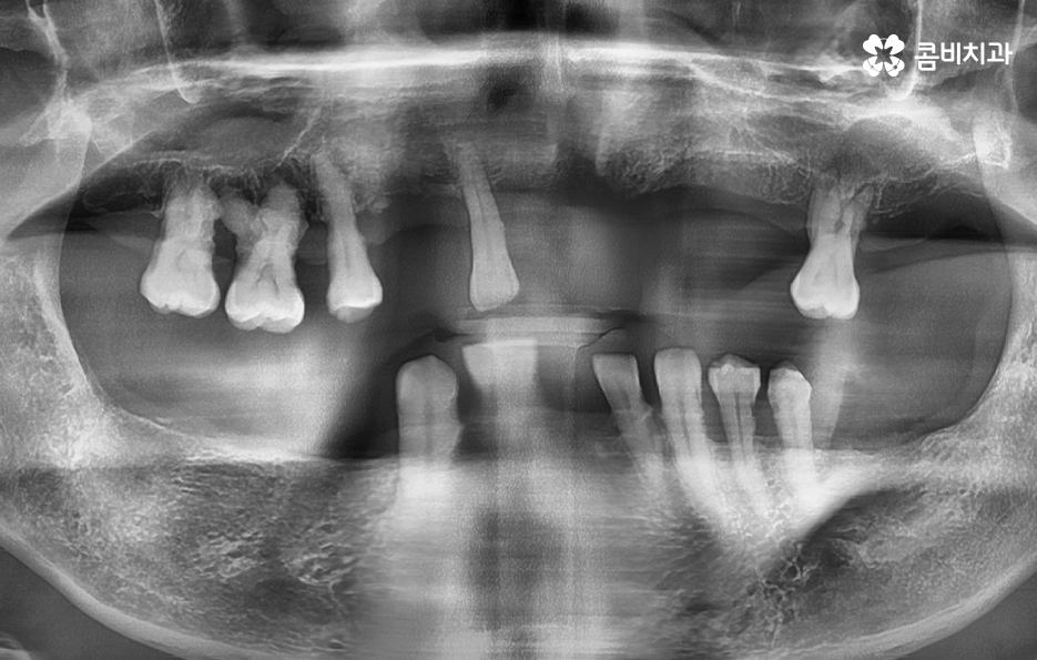 전체임플란트 어떤 방식으로 해야하나요 관련 이미지 1