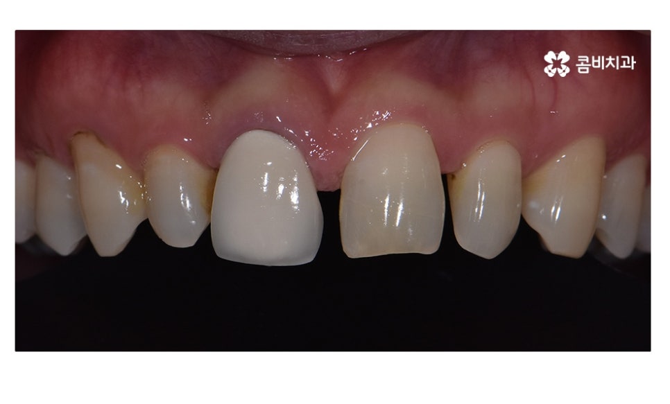 무삭제라미네이트 포인트부터 잘 알고 시작하려면 관련 이미지 4