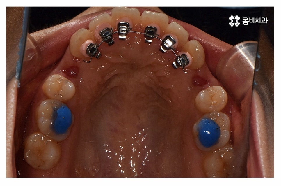 돌출입치아교정 적극적으로 해결하려면 관련 이미지 9