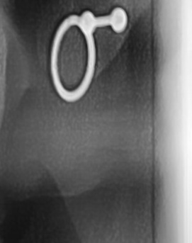 어금니 뒤 잇몸 부음 어떤 문제길래 이런거죠 관련 이미지 37