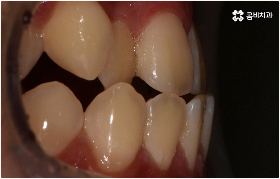 부정교합 3급 고치는 방법은 관련 이미지 2