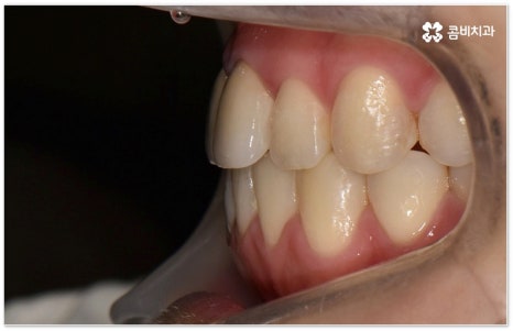 치아교정장치 어떻게 고르나요 관련 이미지 16
