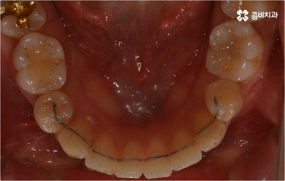 돌출입 치아교정 부모와 아이가 함께 알아봐요 관련 이미지 16