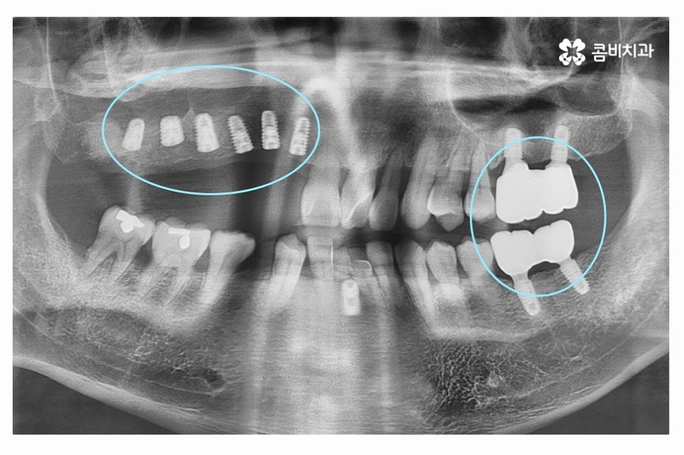 임플란트 수술 신중하게 결정하려면 관련 이미지 6