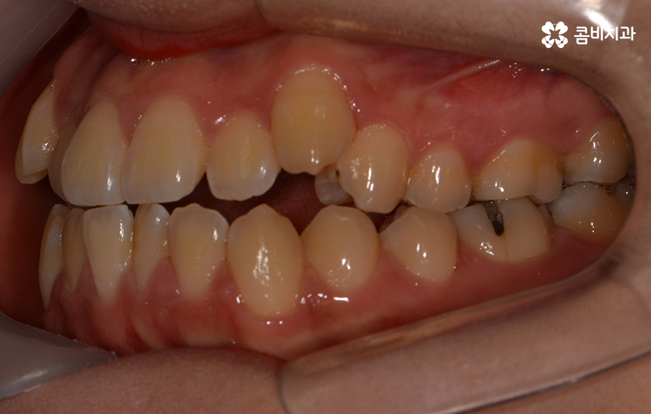 송곳니 덧니 뽑지 않고 해결된 사례 관련 이미지 3