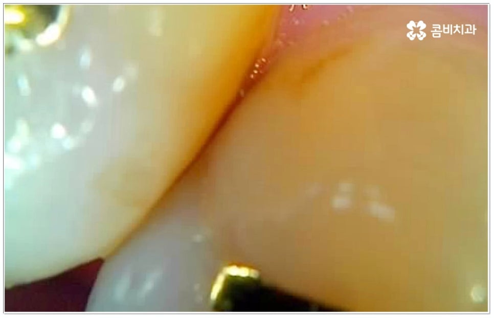 충치 인레이 언제 받나요? 관련 이미지 6