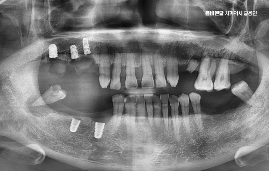 어금니 발치후 임플란트 안하면 어떻게 변하는걸까 관련 이미지 5