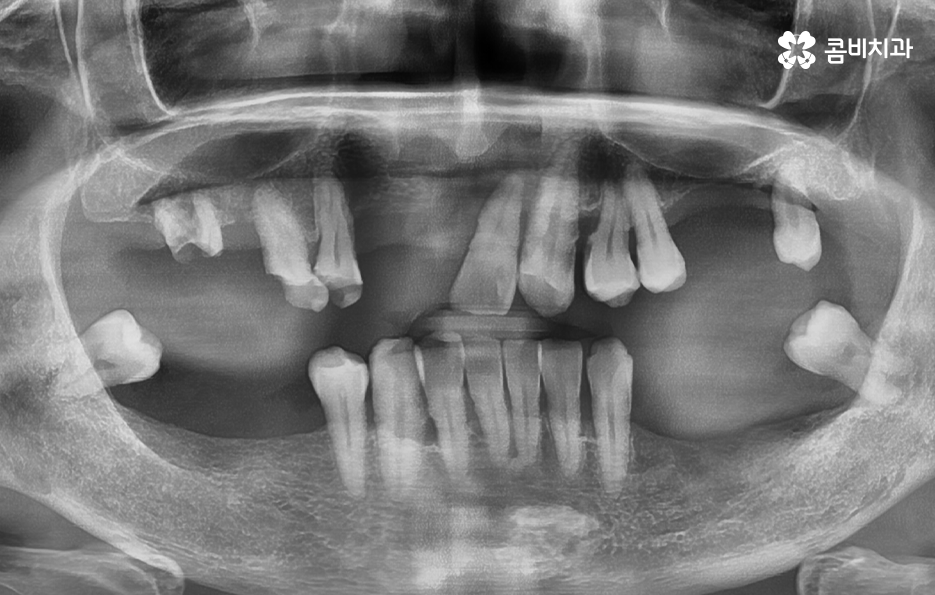 65세이상 임플란트 개수 구체적으로 체크하려면 관련 이미지 2