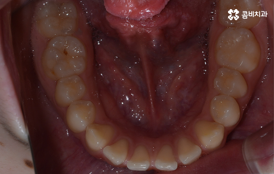 치아 벌어짐 교정으로 앞니 돌출까지 해결하기 관련 이미지 5