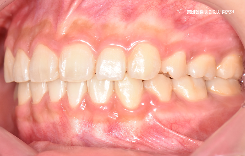 과개교합 교정 후 얼굴형 얼마나 바뀌나요 관련 이미지 11