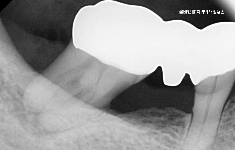 어금니 임플란트 뼈이식 이럴때 해당됩니다 관련 이미지 4