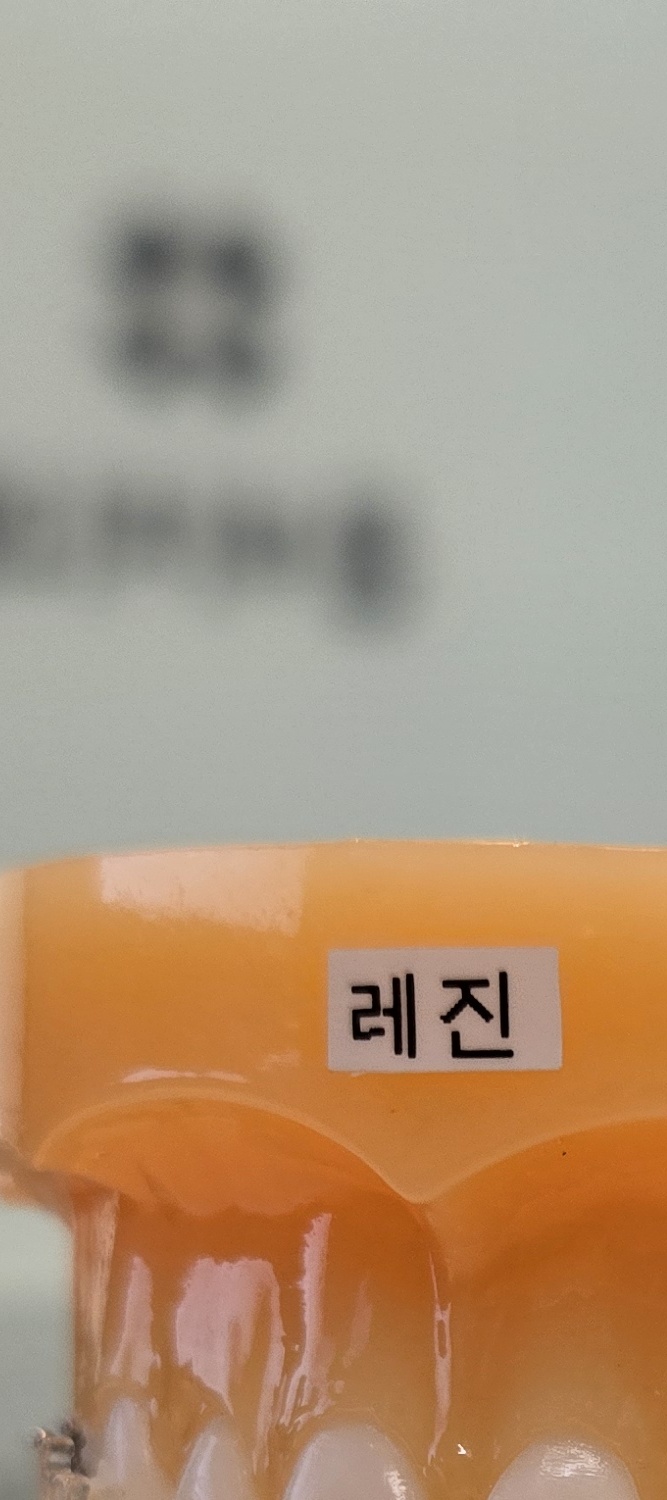 송곳니 덧니 발치 이럴때 해당되네요 관련 이미지 14