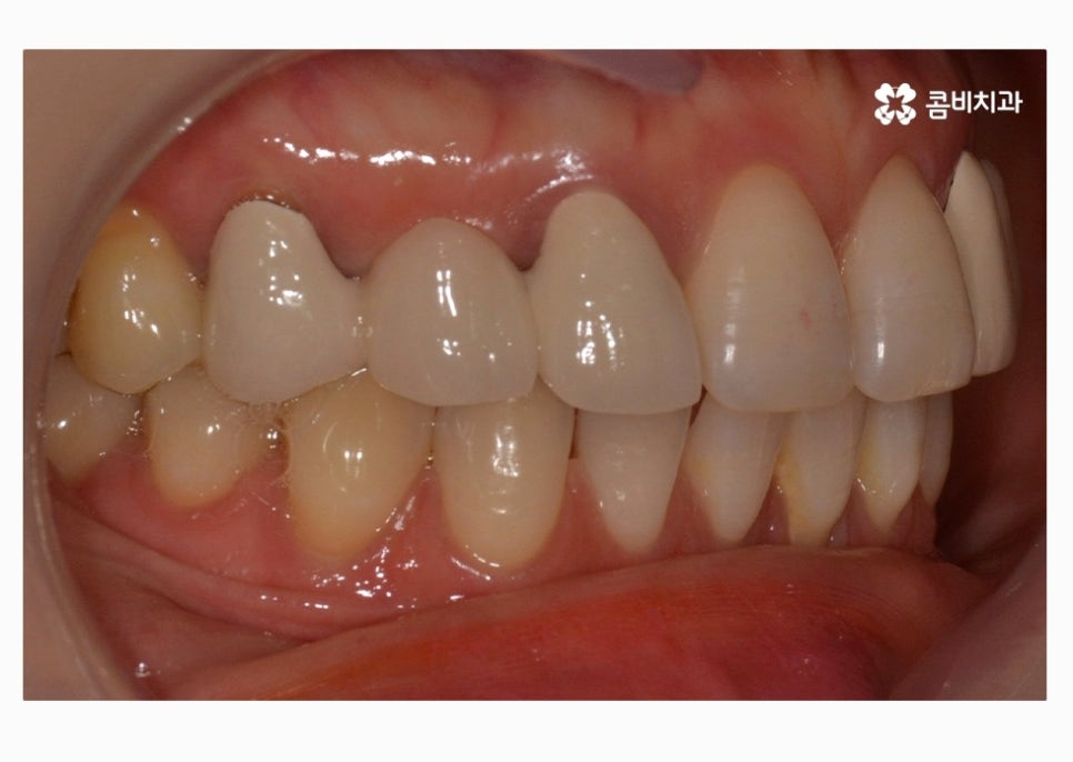 30대임플란트 향후 미래를 바라본다면 관련 이미지 3