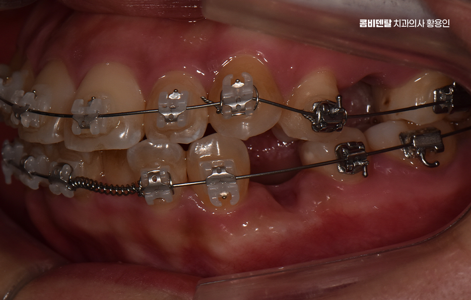 Could the Cause of Protruding Front Teeth Make a Difference? image 9