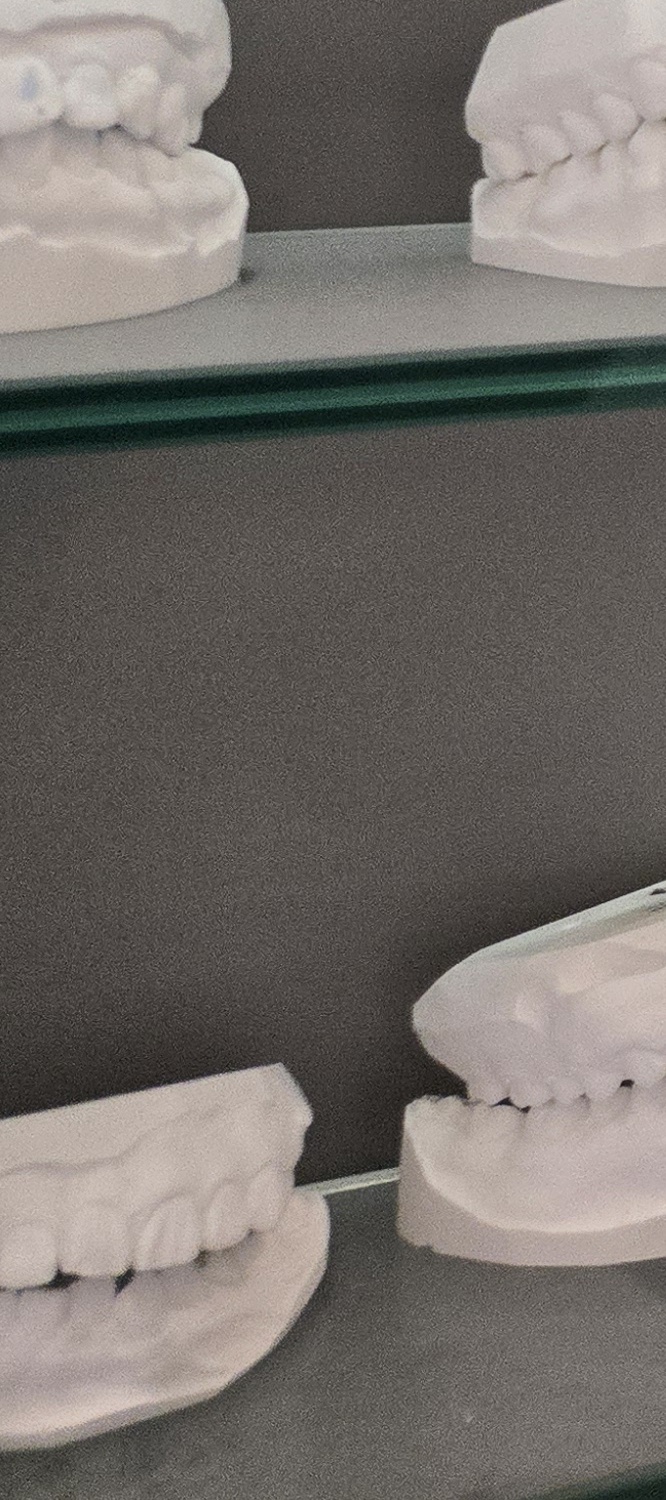 앞니 틀어짐 교정 이렇게 파악하세요 관련 이미지 16