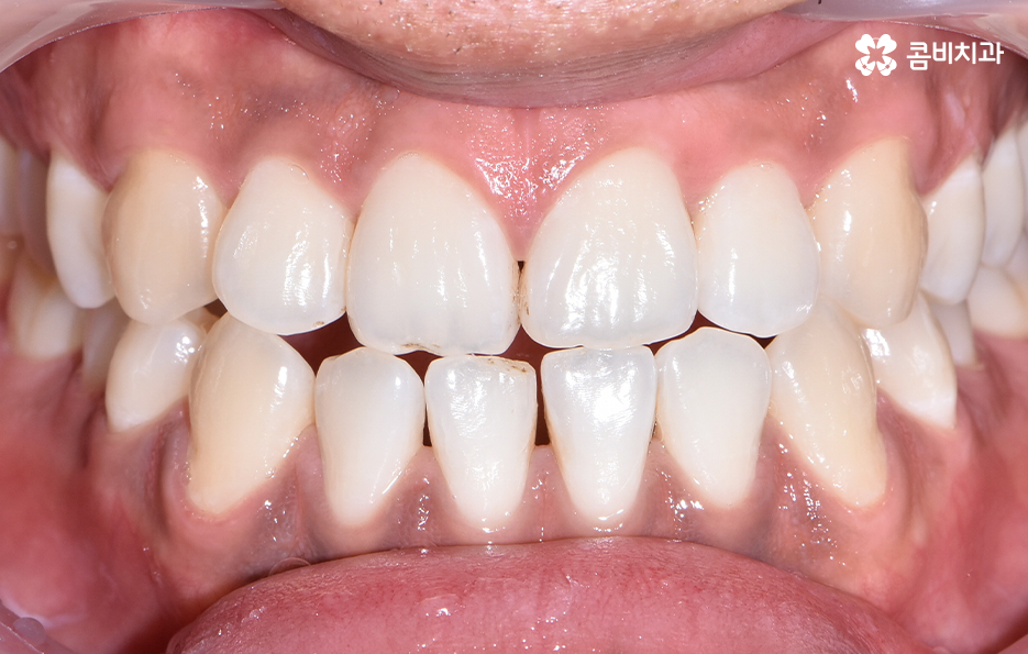 성인 부정교합 교정 더는 미루고 싶지 않다면 관련 이미지 2
