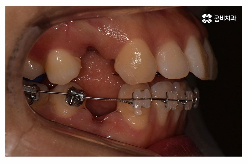 돌출입치아교정 적극적으로 해결하려면 관련 이미지 7