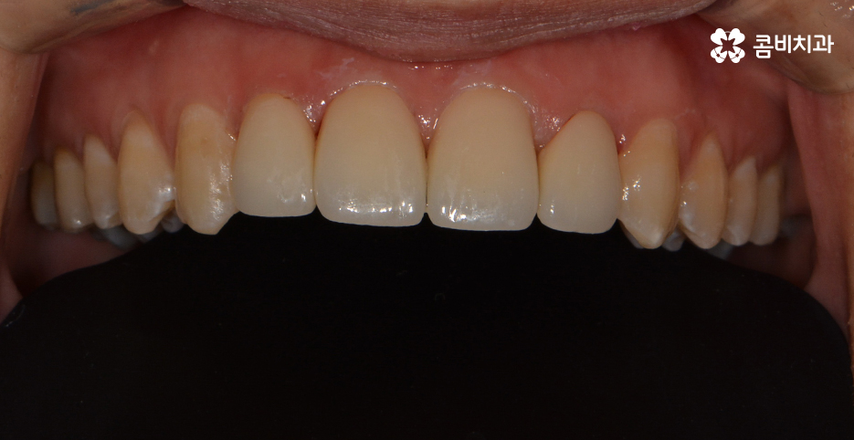 앞니 깨짐 치료와 교정이 병행되었던 사례 관련 이미지 10