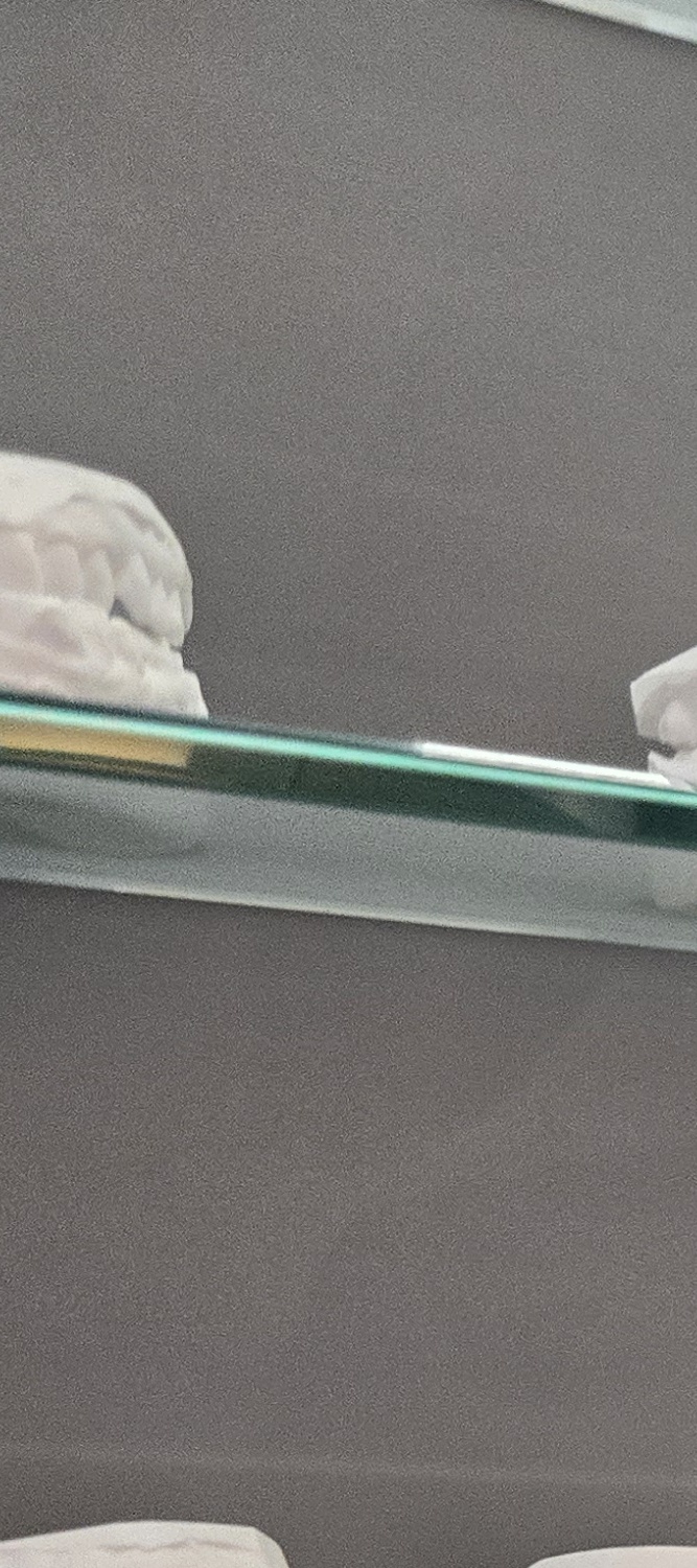 앞니 틀어짐 교정 이렇게 파악하세요 관련 이미지 11