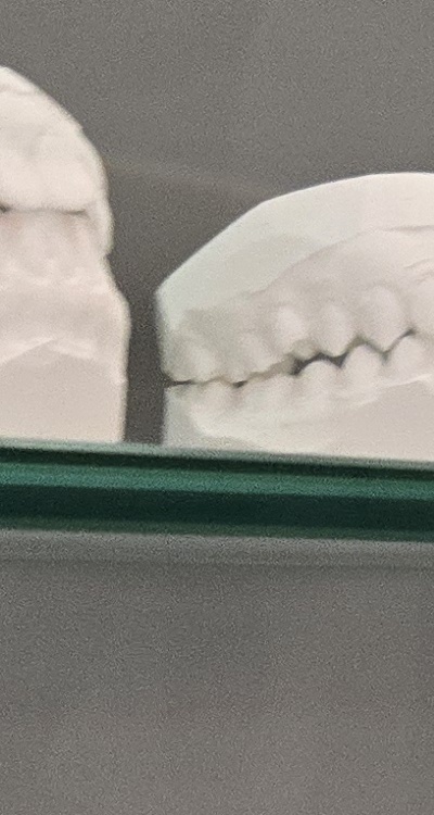 사랑니 주변 잇몸 통증 지금부터가 중요하니까 관련 이미지 26