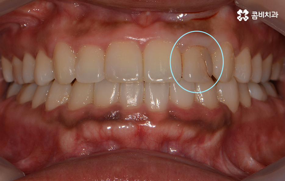 앞니 충치치료 개인에 따라 달라지는 이유 관련 이미지 3