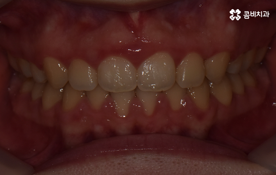 치아 벌어짐 교정으로 앞니 돌출까지 해결하기 관련 이미지 8